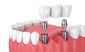 Illustration of implant bridge