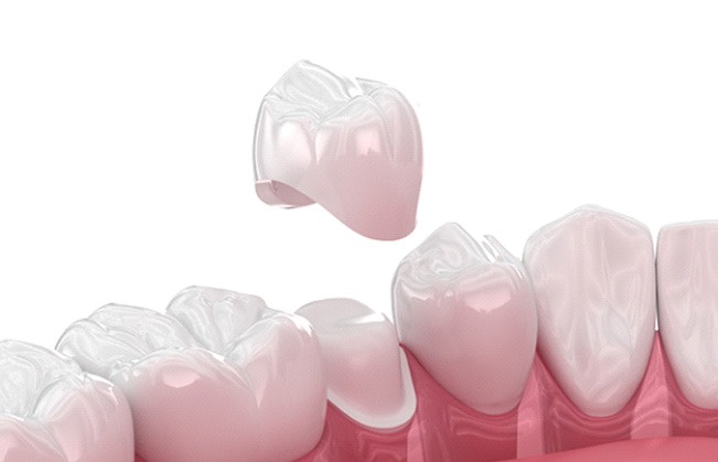 Digital illustration of dental crown being placed on tooth