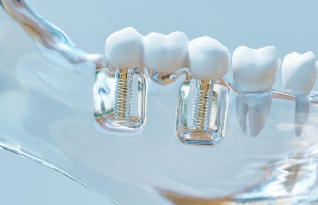 Model smile with dental implant supported fixed bridge