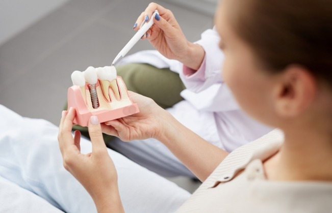 Dentist using smile model to explain the four step dental implant process