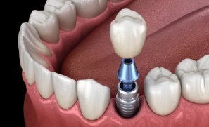 Animated smile during dental implant supported dental crown placement