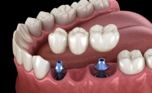 Animated smile during dental implant supported fixed bridge placement