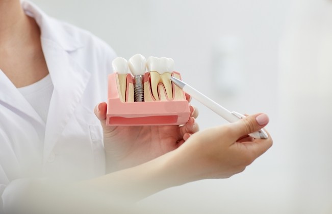 Dentist explaining the cost of dental implants