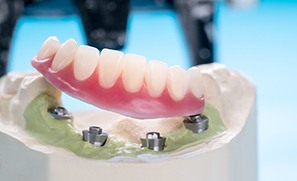 Example of implant dentures at Complete Dental Care of Renton