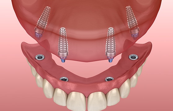 Illustration of an implant denture in Renton, WA being placed on upper arch