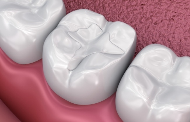 Animated smile with dental sealants