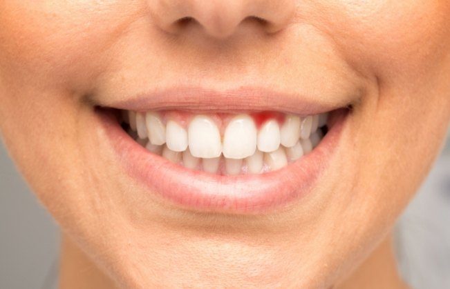 Woman with red soft tissue before gum disease treatment