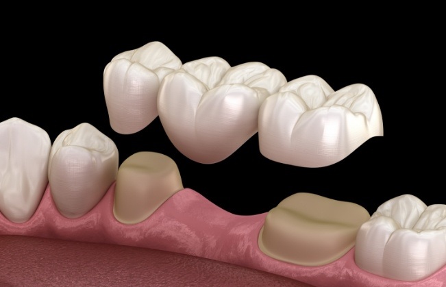 Animated smile during dental bridge placement