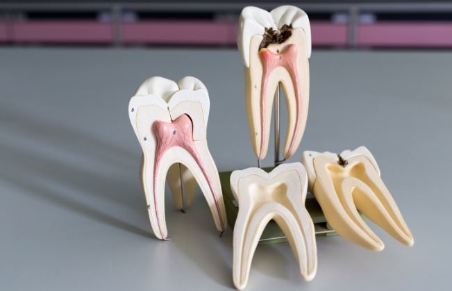 Model of healthy tooth compared to tooth in need of root canal treatment