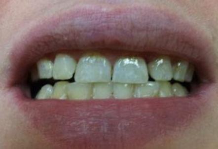 Healthy beautiful smile after dental treatment