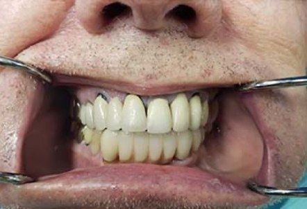 Smile after bottom teeth are replaced