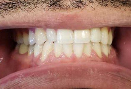 Smile after missing top tooth is replaced