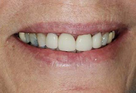 Smile after damage and gum tissue recession is restored