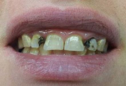 Smile with severe decay before dental treatment