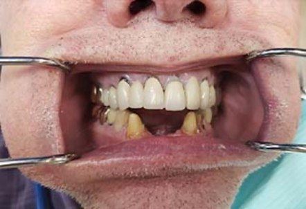 Smile with missing bottom teeth