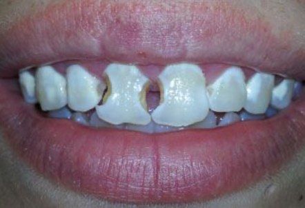 Front teeth with severe decay