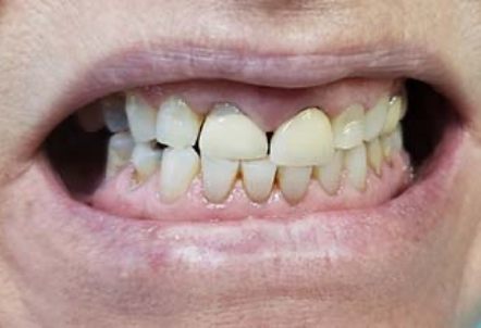 Smile with damaged teeth and receding gums