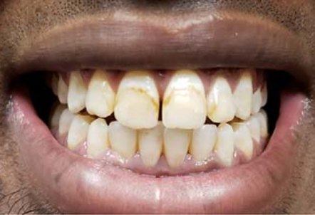 Discolored teeth