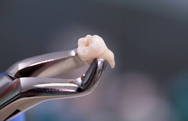 Metal clasp holding extracted tooth