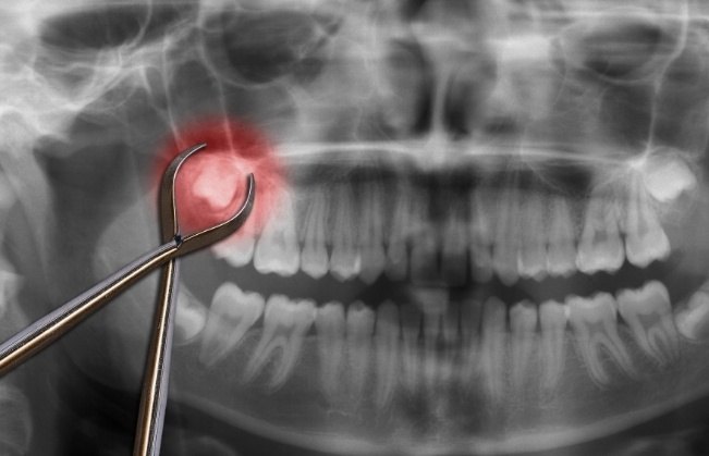 X ray of smile with impacted wisdom tooth before extraction