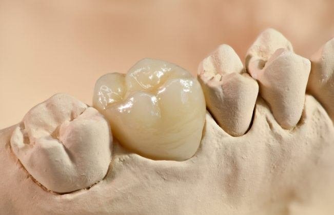 A Guide to Cavity Fillings in Renton: How Long Does It Take?